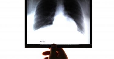 estenose pulmonar
